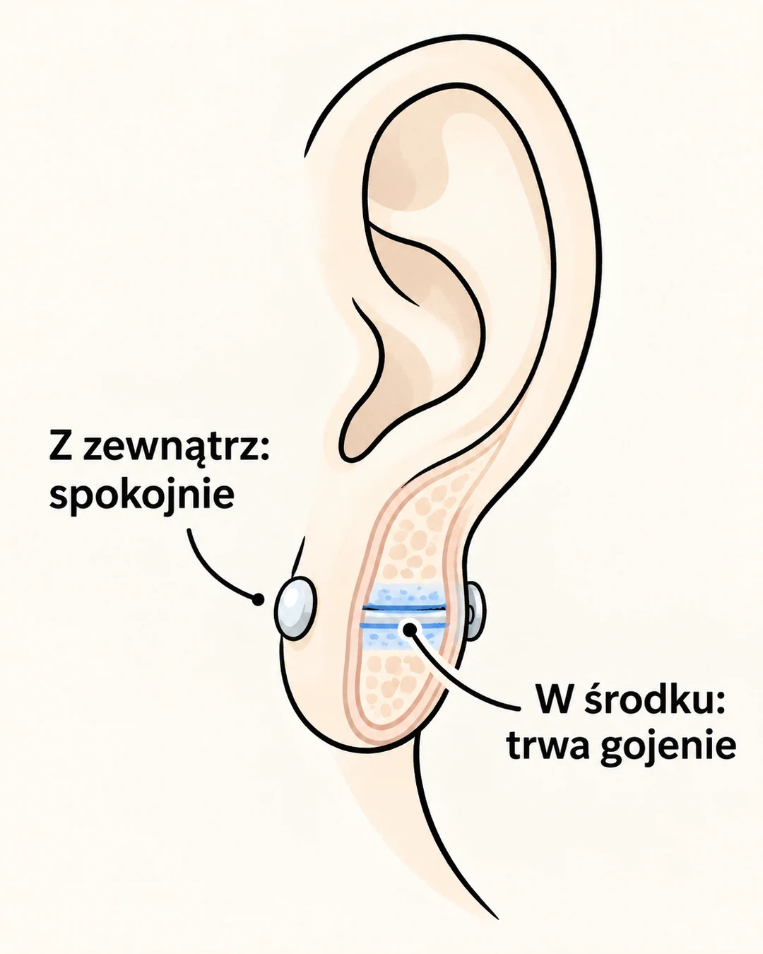 Przekrój płatka ucha pokazuje spokojną powierzchnię i nadal gojący się kanał.