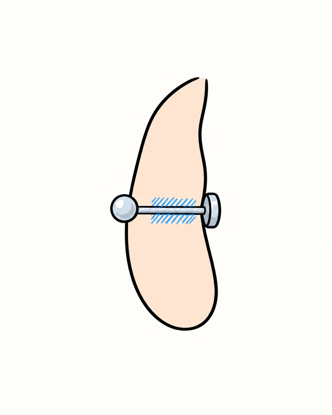 Schematische oorlel met rustig oppervlak en blauw gemarkeerd weefsel rond het piercingkanaal.